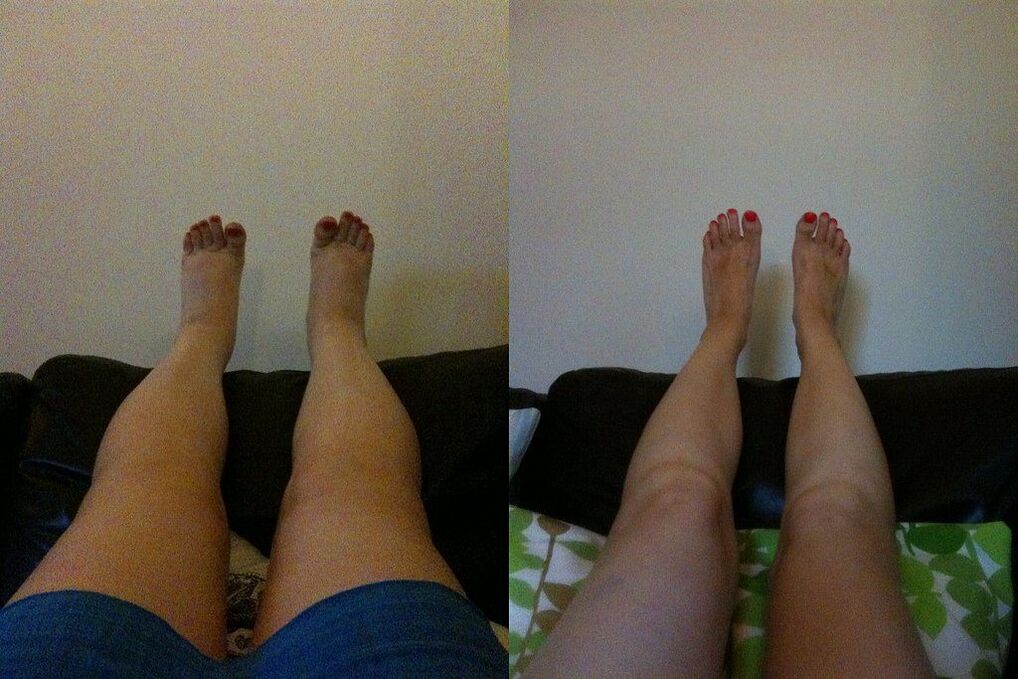Effective result before and after the application of Ostelife Premium Plus cream from Margarita