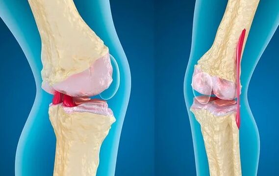 Gonarthrosis of the 3rd degree of knee articulation