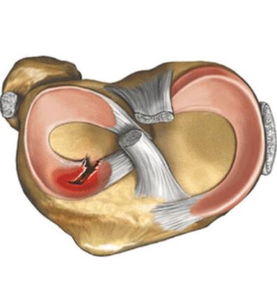 Meniscus lesion