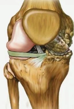 Osteoarthritis of the knee joint