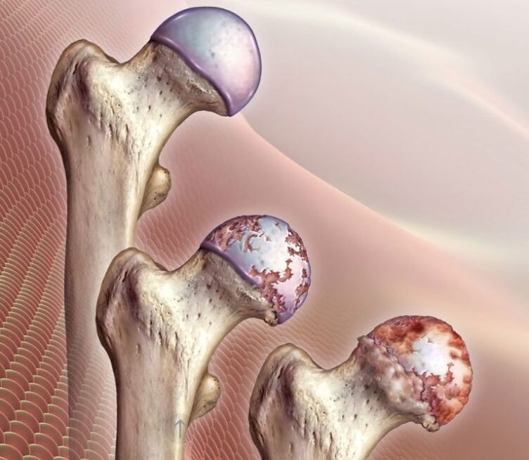 Hip joint articulation