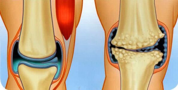 The normal state of the joint and the causes of the development of knee osteoarthritis