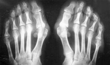 Differential diagnosis of symptoms of arthritis and osteoarthritis