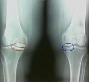 The result of the treatment of folk remedies of arthritis and osteoarthritis