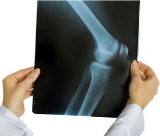 X-ray of osteoarthritis of the knee joint