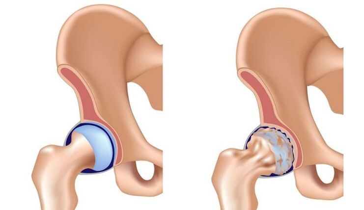 Healthy and articulation with osteoarthritis
