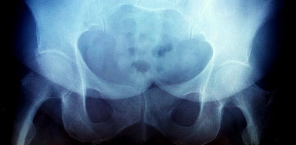 X-ray image with 2nd degree osteoarthritis